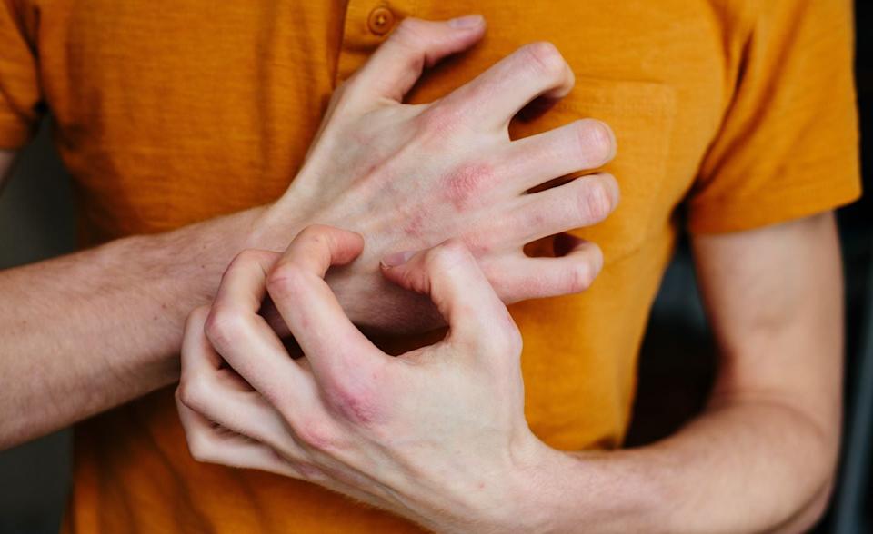 الأكزيما: الأعراض والعلاج وما علاقتها بالطعام؟